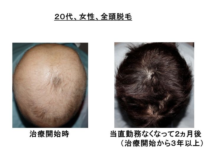 円形脱毛症　病院